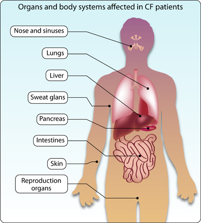Figure 1: Characteristics of cystic fibrosis (CF)