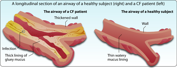 Figure 3: Thick mucus of the epithelial cells obstructs the airways and triggers infections in patients