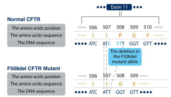 Figure 4: the sequences of nucleotides (in blue) and the amino acids (in brown) in a normal and F508del mutated CFTR. The nucleotides that are missing in the mutant allele are marked (in light blue).