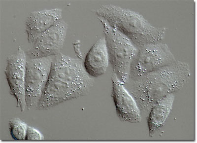 תאי אפיתל ממאירים שהוצאו מגוף של חולה